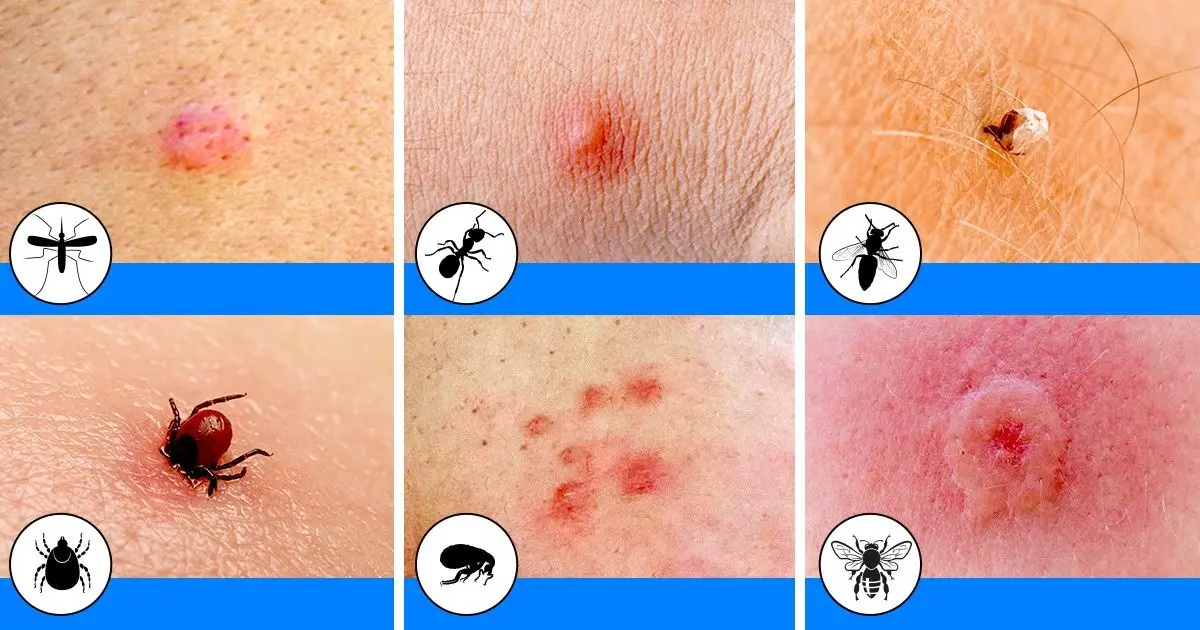 10 Bug Bites Anyone Should Be Able to Identify