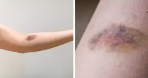 Bruises